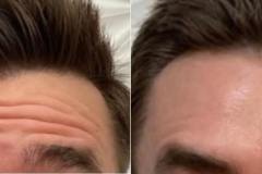 botox3
