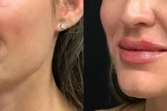 fillers1