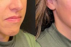 fillers6