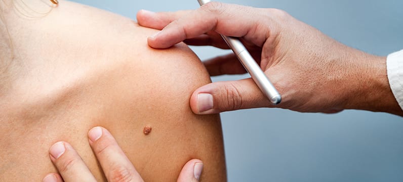 Mole Removal South Miami FL