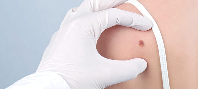 Sun Damaged Skin Treatment South Miami FL