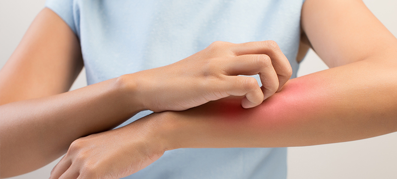 Eczema Treatment South Miami FL