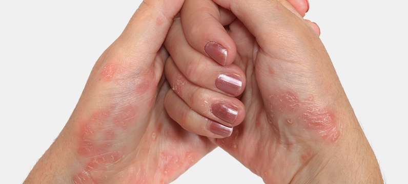Psoriasis Treatment South Miami FL