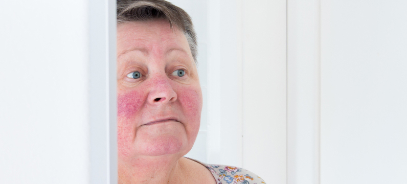 Rosacea Treatment South Miami FL