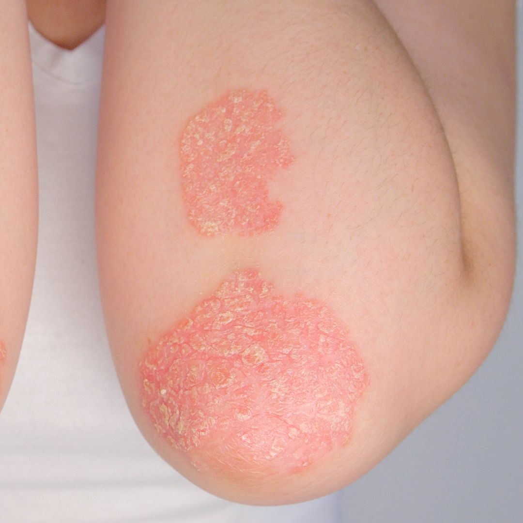 Eczema Doctor South Miami FL