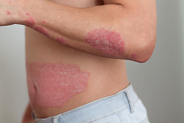 Psoriasis Doctor South Miami FL