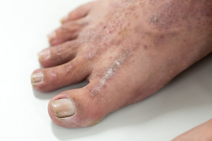 Pustular Psoriasis Treatment Pinecrest FL
