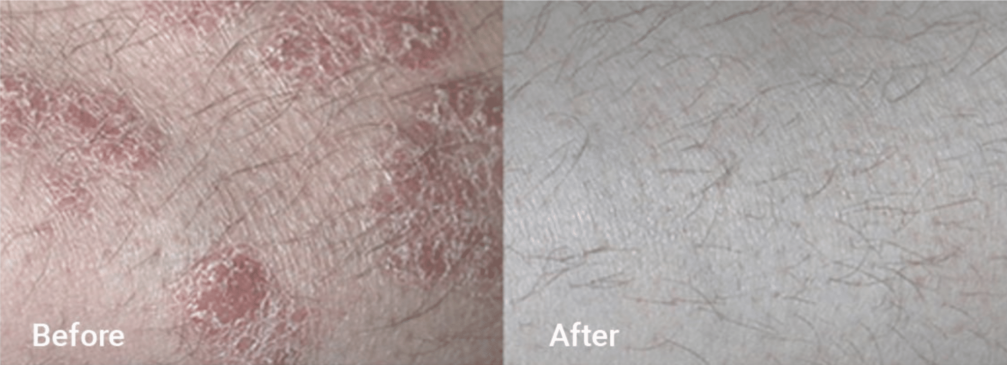 Light Therapy Psoriasis After Image Pinecrest FL