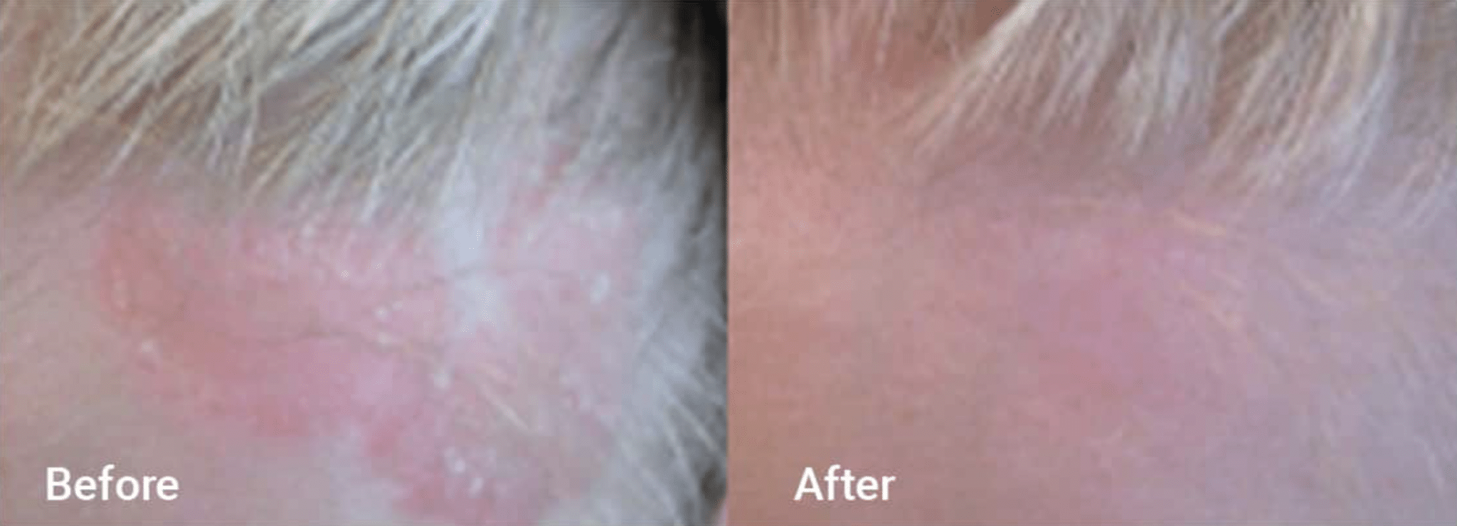 Light Therapy Psoriasis Before Image South Miami FL
