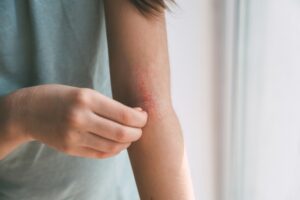 A close-up shot of a woman with eczema on her arm