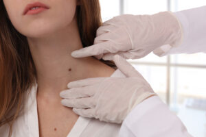 Dermatology provider wearing gloves while examining a patient’s mole during a skin check.
